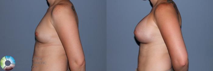 Before & After Breast Augmentation Case 11557 Left Side View in Golden, CO