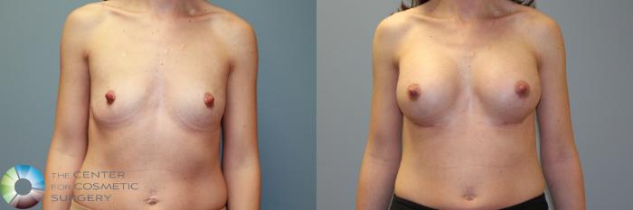 Before & After Breast Augmentation Case 11559 Front in Denver, CO