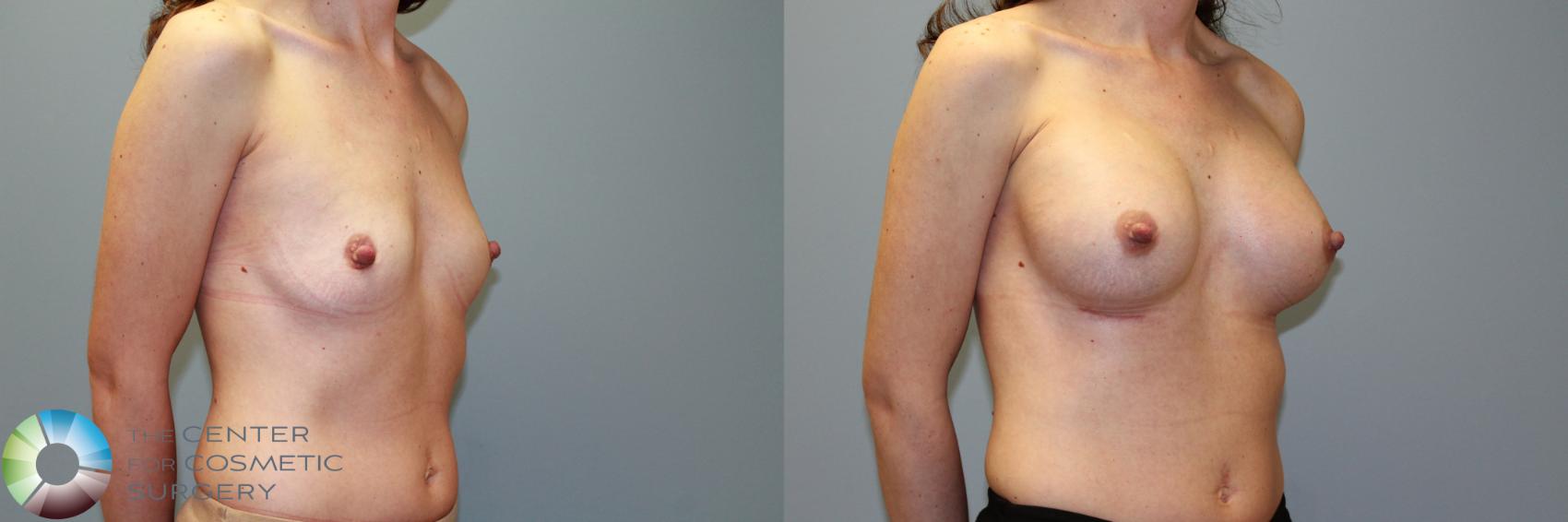 Before & After Breast Augmentation Case 11559 Right Oblique View in Golden, CO