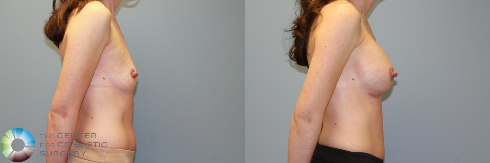 Before & After Breast Augmentation Case 11559 Right Side View in Golden, CO