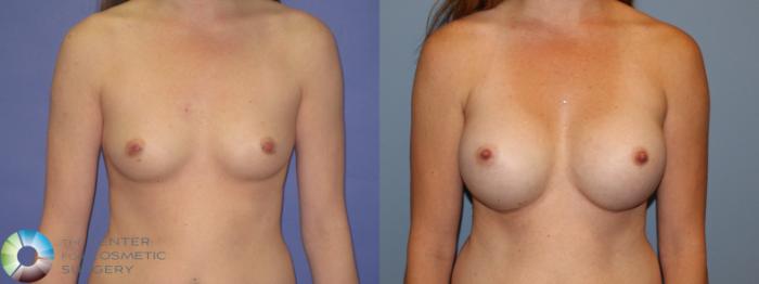 Before & After Breast Augmentation Case 11560 Front View in Golden, CO