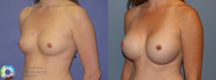 Before & After Breast Augmentation Case 11560 Left Oblique View in Golden, CO