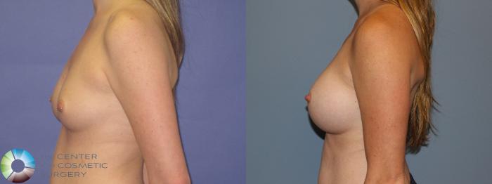 Before & After Breast Augmentation Case 11560 Left Side View in Golden, CO