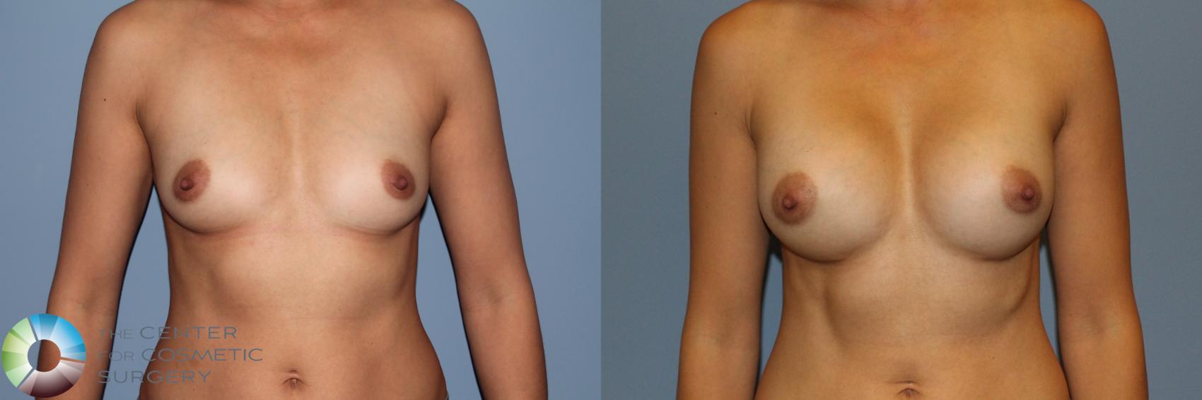 Before & After Breast Augmentation Case 11561 Front View in Golden, CO