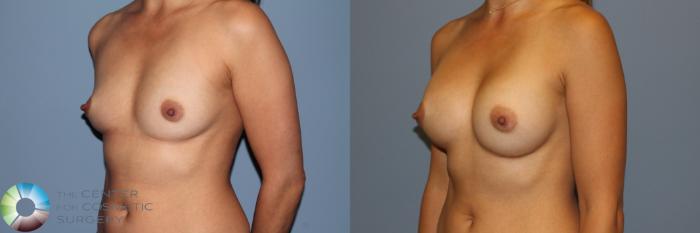 Before & After Breast Augmentation Case 11561 Left Oblique View in Golden, CO