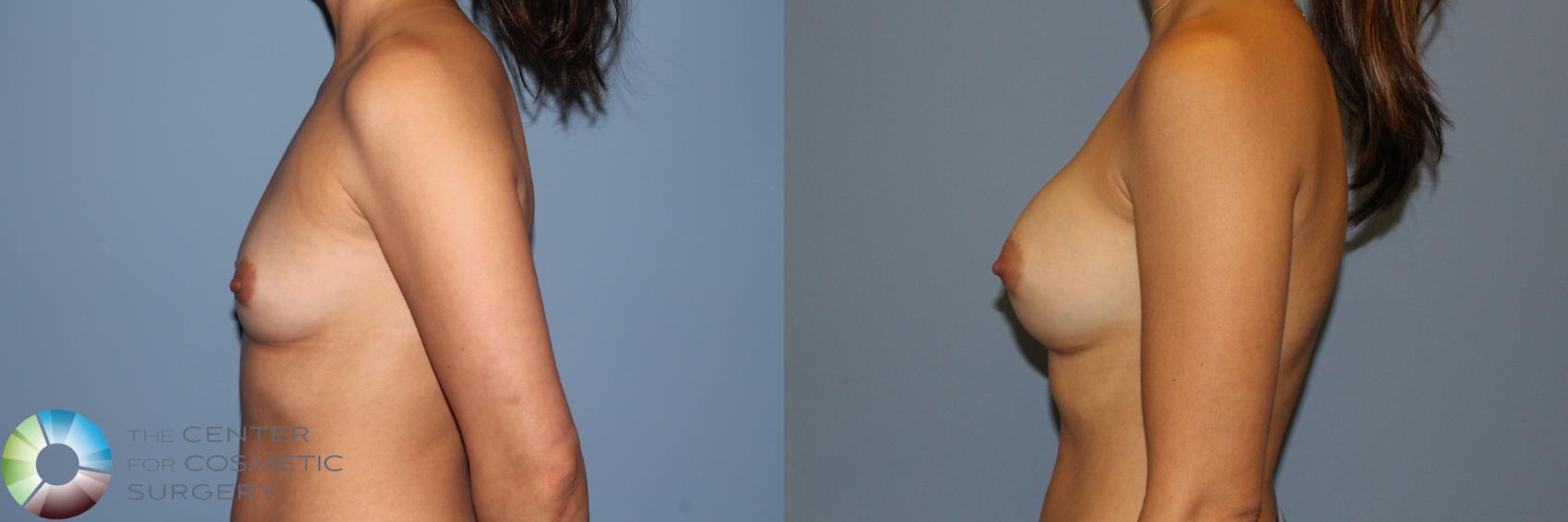 Before & After Breast Augmentation Case 11561 Left Side View in Golden, CO
