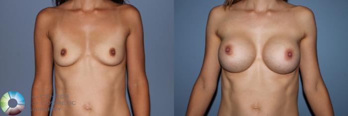 Before & After Breast Augmentation Case 11563 Front in Denver and Colorado Springs, CO
