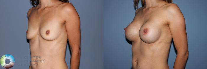 Before & After Breast Augmentation Case 11563 Left Oblique in Denver and Colorado Springs, CO