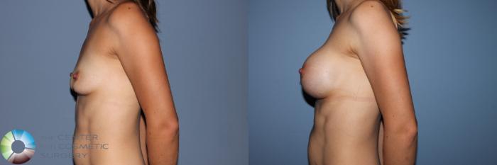 Before & After Breast Augmentation Case 11563 Left Side in Denver and Colorado Springs, CO