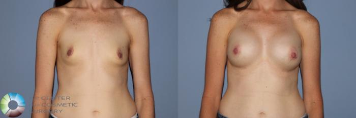 Before & After Breast Augmentation Case 11564 Front in Denver and Colorado Springs, CO