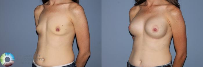 Before & After Breast Augmentation Case 11564 Left Oblique in Denver and Colorado Springs, CO