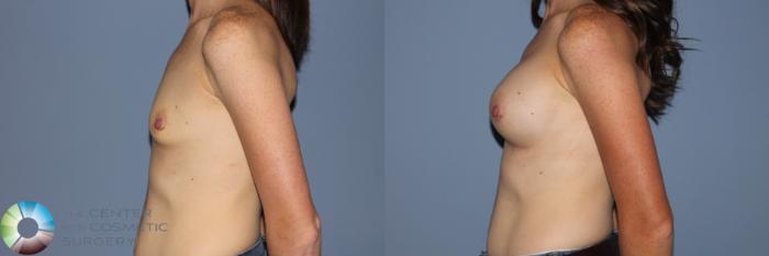 Before & After Breast Augmentation Case 11564 Left Side in Denver and Colorado Springs, CO
