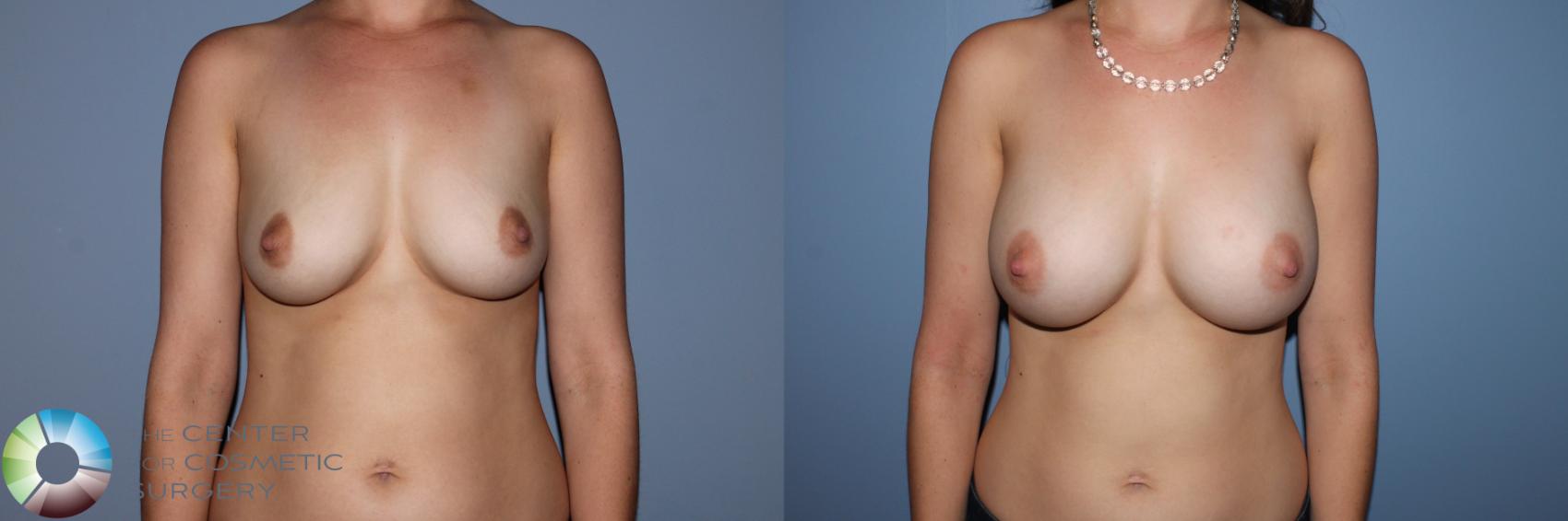 Before & After Breast Augmentation Case 11565 Front View in Golden, CO