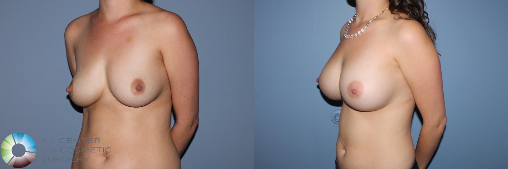 Before & After Breast Augmentation Case 11565 Left Oblique in Denver and Colorado Springs, CO