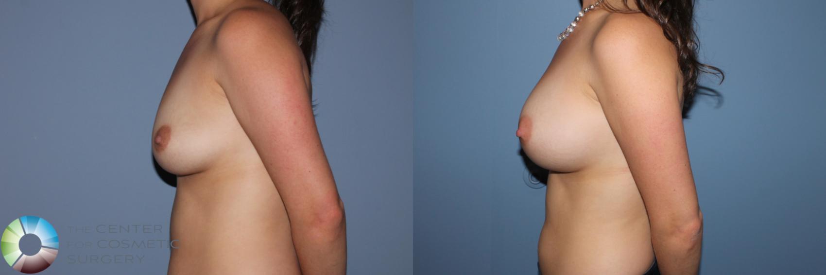 Before & After Breast Augmentation Case 11565 Left Side in Denver and Colorado Springs, CO