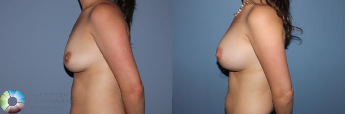 Before & After Breast Augmentation Case 11565 Left Side View in Golden, CO