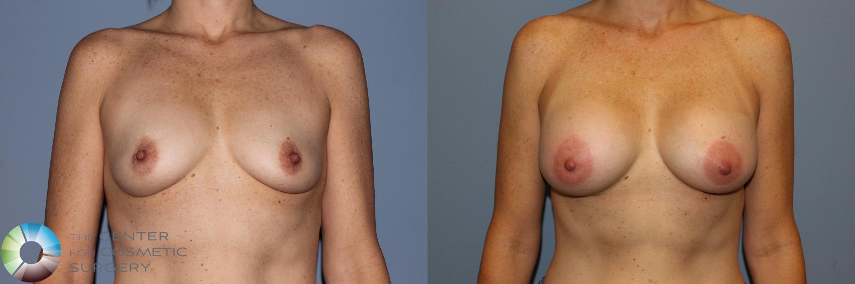 Before & After Breast Augmentation Case 11574 Front in Denver and Colorado Springs, CO