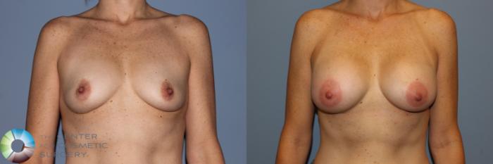 Before & After Breast Augmentation Case 11574 Front View in Golden, CO