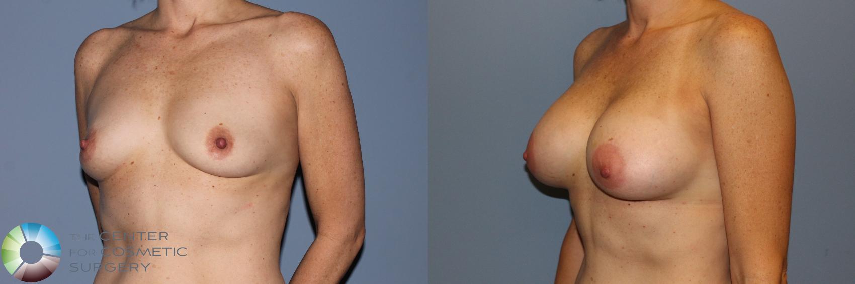 Before & After Breast Augmentation Case 11574 Left Oblique in Denver and Colorado Springs, CO