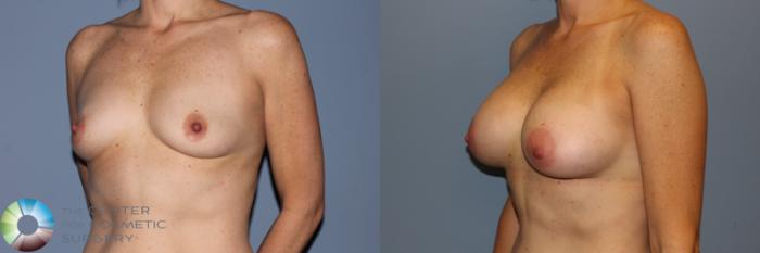 Before & After Breast Augmentation Case 11574 Left Oblique View in Golden, CO