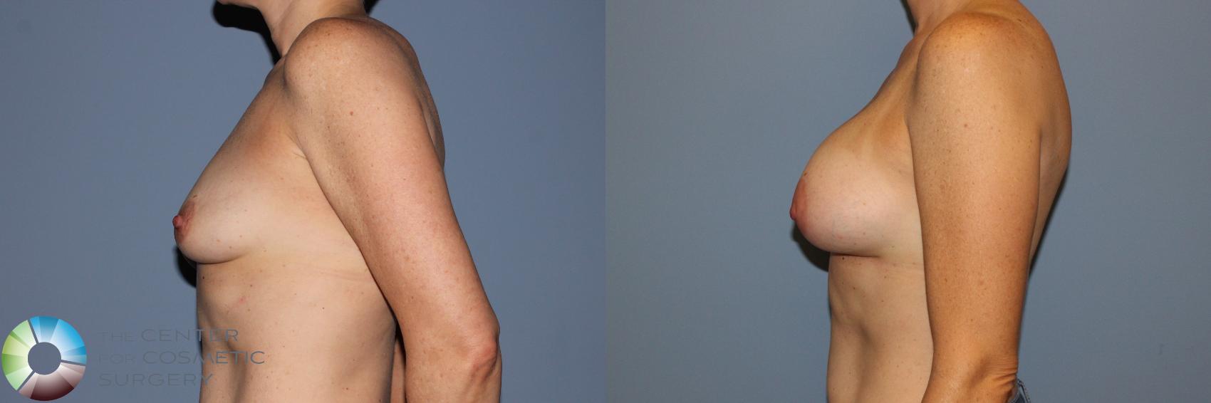 Before & After Breast Augmentation Case 11574 Left Side in Denver and Colorado Springs, CO