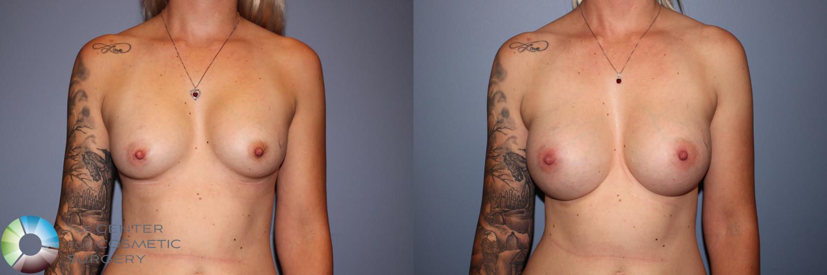 Before & After Breast Augmentation Case 11575 Front View in Golden, CO