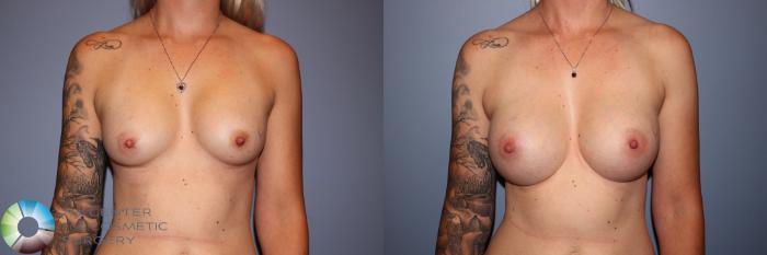 Before & After Breast Implant Revision Case 11575 Front in Denver and Colorado Springs, CO