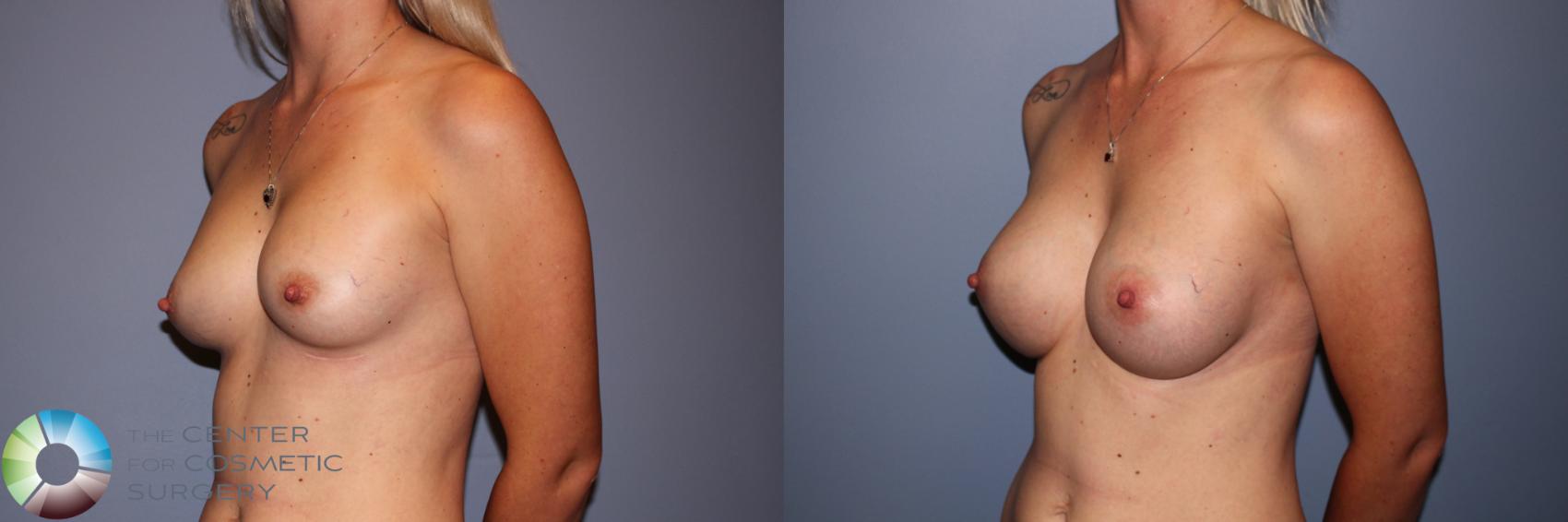 Before & After Breast Augmentation Case 11575 Left Oblique View in Golden, CO