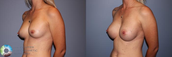 Before & After Breast Implant Revision Case 11575 Left Oblique in Denver and Colorado Springs, CO