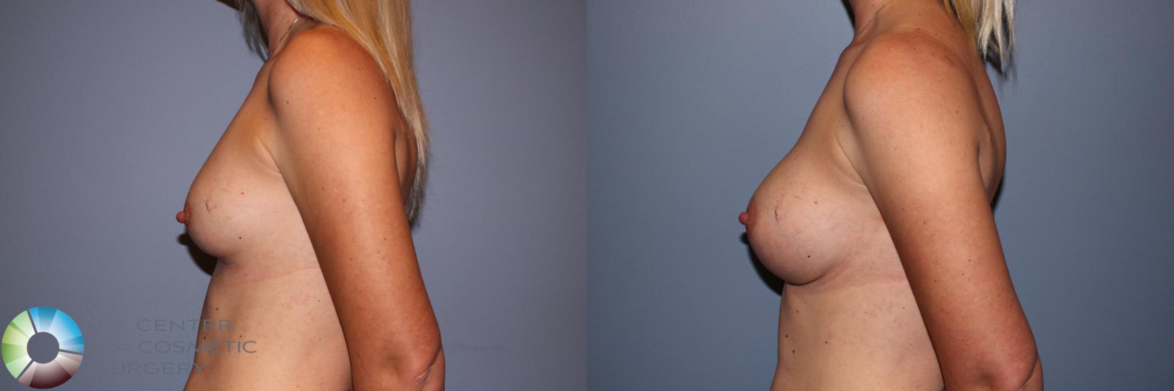 Before & After Breast Augmentation Case 11575 Left Side View in Golden, CO
