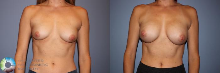 Before & After Breast Augmentation Case 11576 Front View in Golden, CO