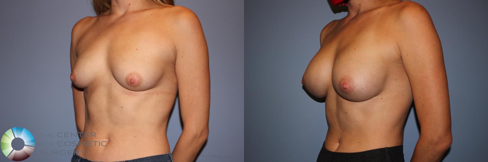 Before & After Breast Augmentation Case 11576 Left Oblique View in Golden, CO