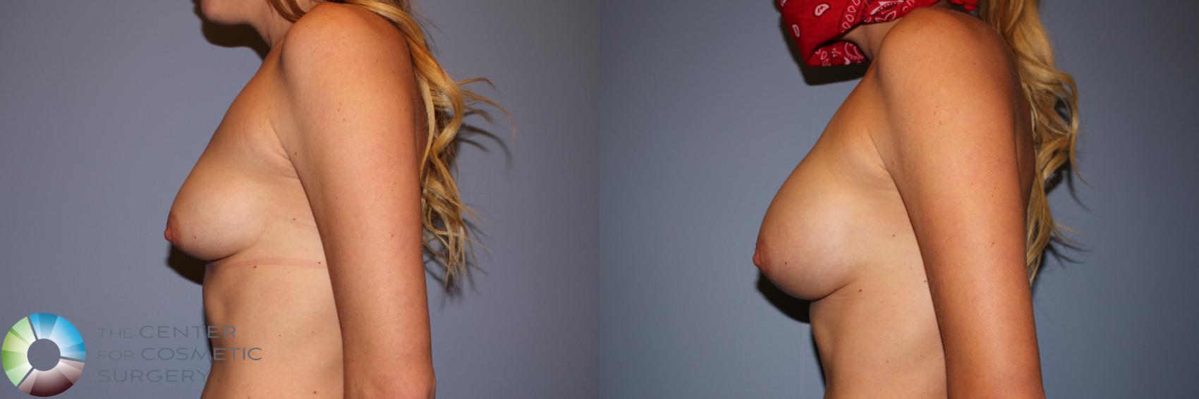 Before & After Breast Augmentation Case 11576 Left Side View in Golden, CO