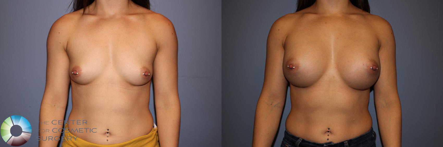 Before & After Breast Augmentation Case 11577 Front in Denver and Colorado Springs, CO