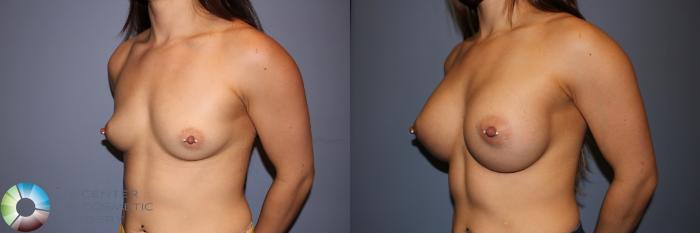 Before & After Breast Augmentation Case 11577 Left Oblique in Denver and Colorado Springs, CO
