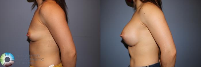 Before & After Breast Augmentation Case 11577 Left Side in Denver and Colorado Springs, CO