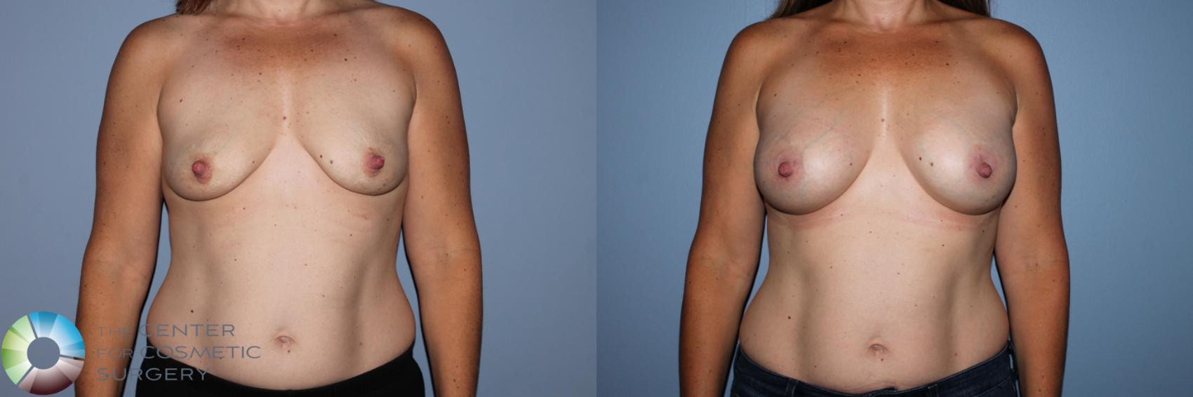 Before & After Breast Augmentation Case 11582 Front View in Golden, CO