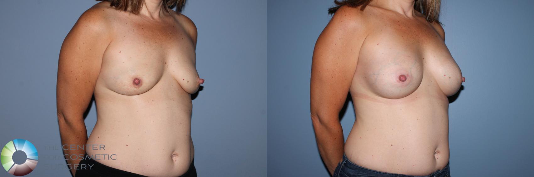 Before & After Breast Augmentation Case 11582 Right Oblique in Denver and Colorado Springs, CO