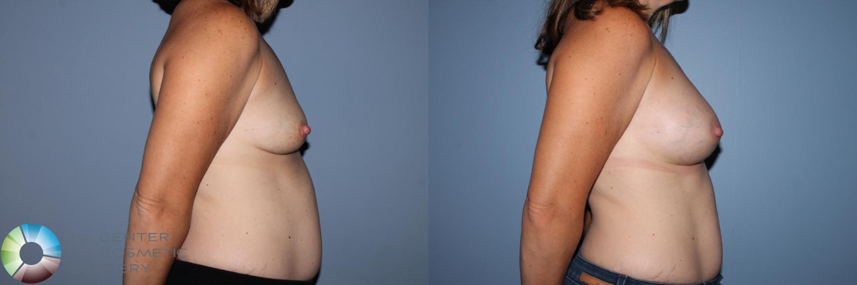 Before & After Breast Augmentation Case 11582 Right Side in Denver and Colorado Springs, CO