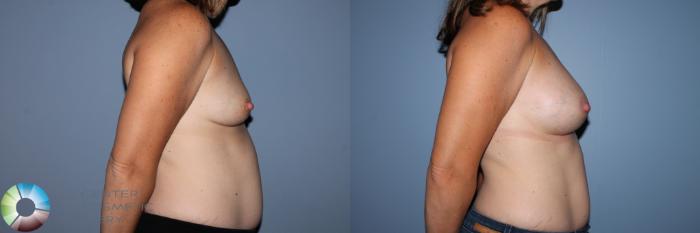 Before & After Breast Augmentation Case 11582 Right Side View in Golden, CO