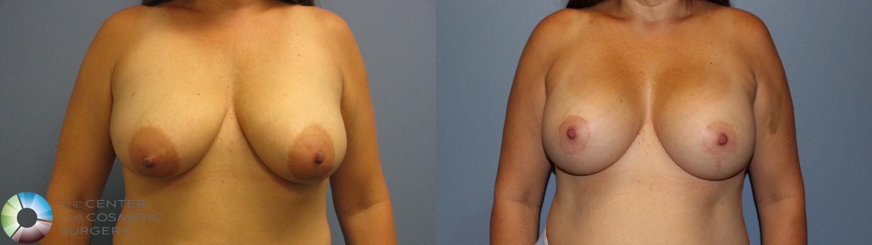 Before & After Breast Augmentation Case 11583 Front in Denver and Colorado Springs, CO