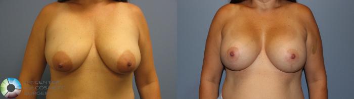 Before & After Breast Augmentation Case 11583 Front View in Golden, CO