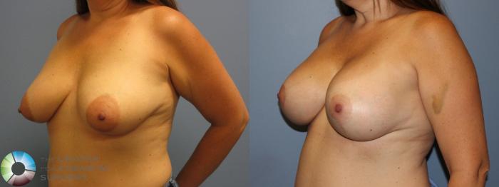 Before & After Breast Augmentation Case 11583 Left Oblique View in Golden, CO