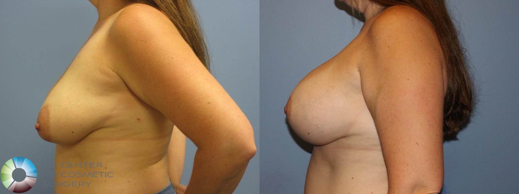 Before & After Breast Augmentation Case 11583 Left Side View in Golden, CO