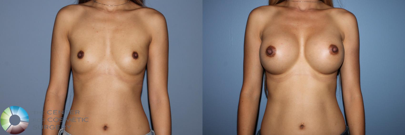 Before & After Breast Augmentation Case 11584 Front View in Golden, CO