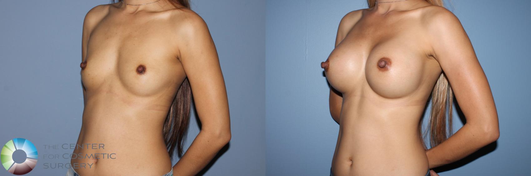 Before & After Breast Augmentation Case 11584 Left Oblique View in Golden, CO