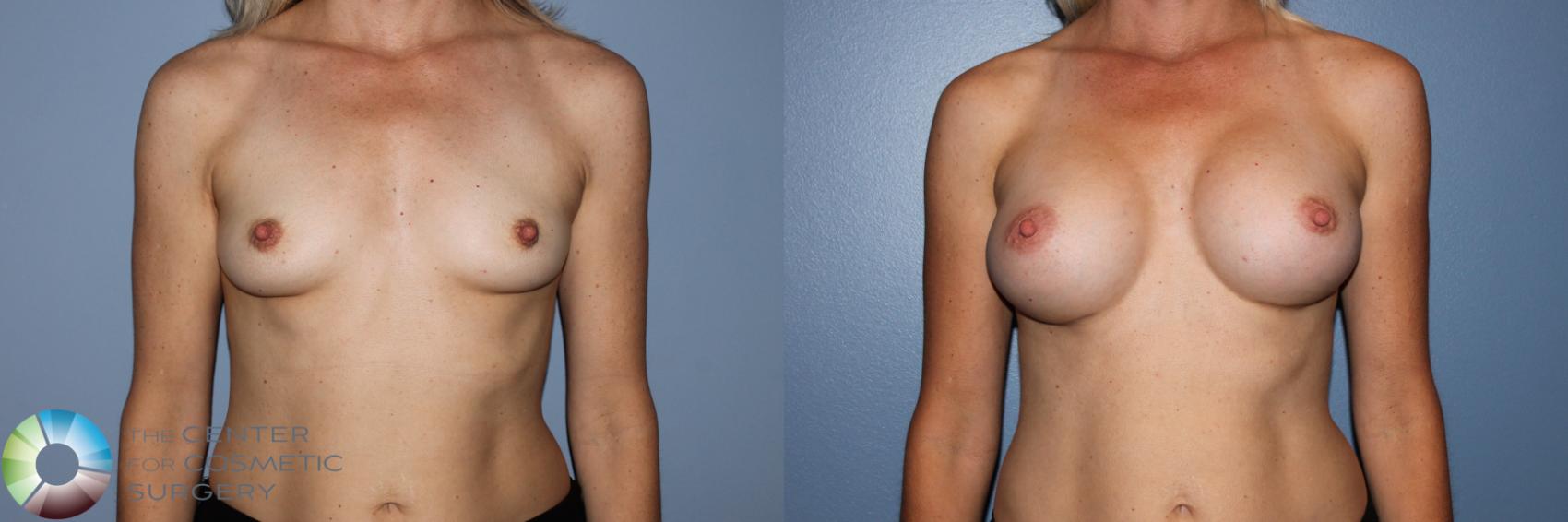 Before & After Breast Augmentation Case 11594 Front in Denver and Colorado Springs, CO