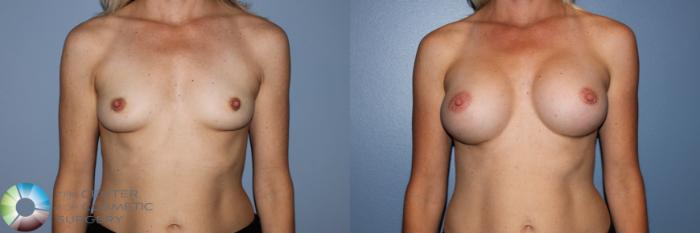 Before & After Breast Augmentation Case 11594 Front View in Golden, CO