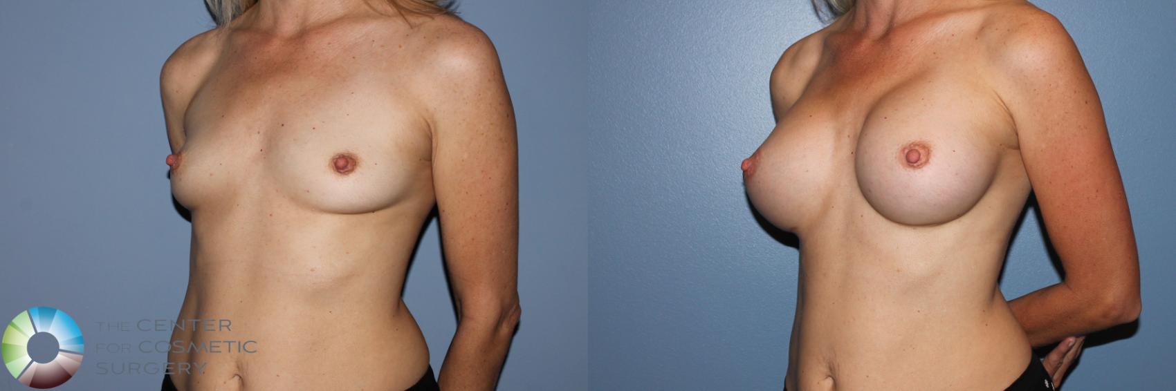 Before & After Breast Augmentation Case 11594 Left Oblique View in Golden, CO
