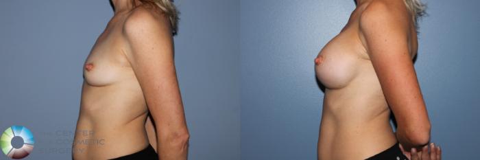 Before & After Breast Augmentation Case 11594 Left Side View in Golden, CO